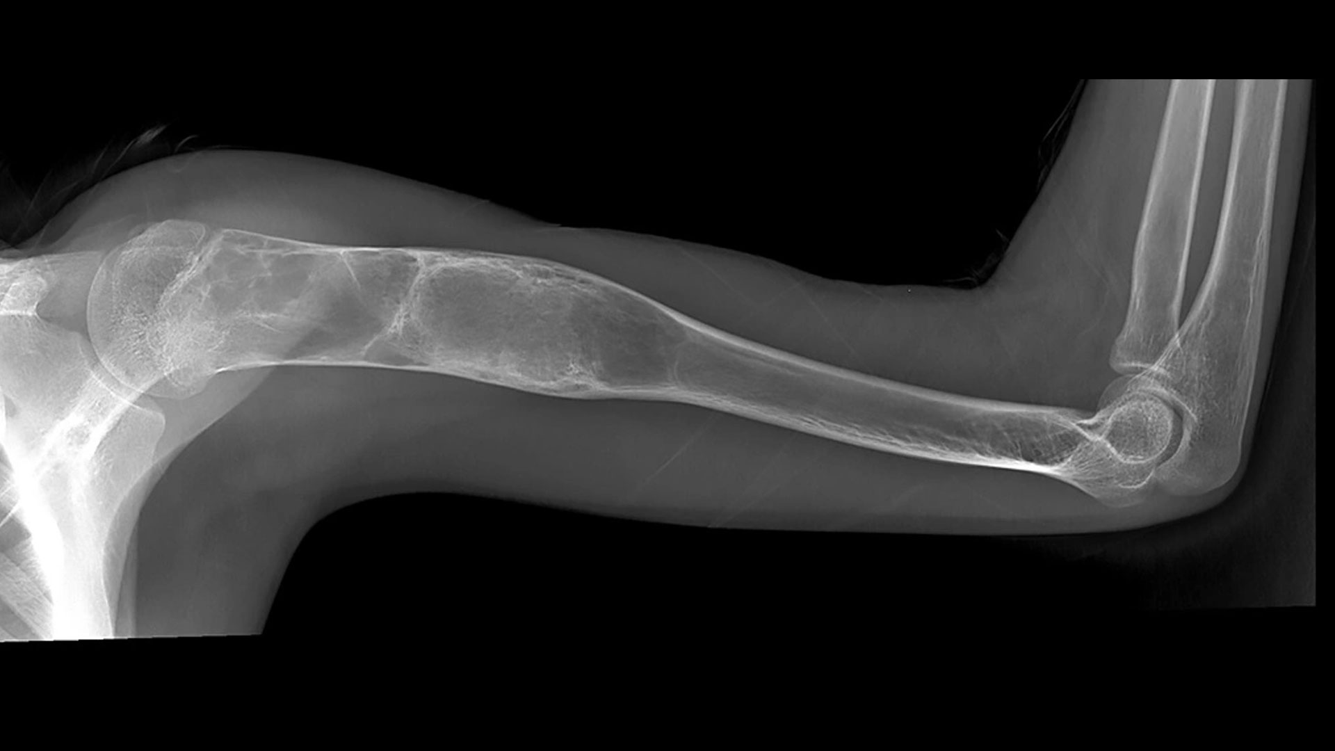 Bone Tumors and Cysts Treatment by Dr. Sourabh Jatkar